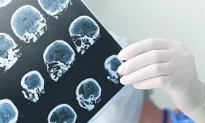 Đột ngột mất thị lực do đột quỵ tuyến yên