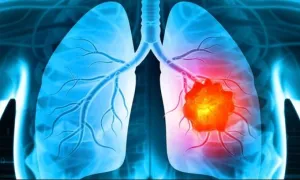 Dấu hiệu âm thầm cảnh báo ung thư phổi